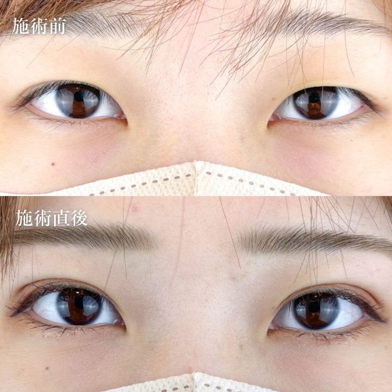 二重埋没法(担当医:TCB 医師)の症例写真1