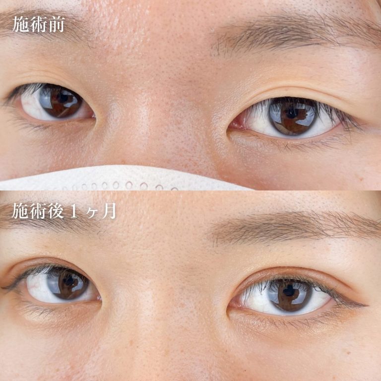 二重埋没法(担当医:TCB 医師)の症例写真2