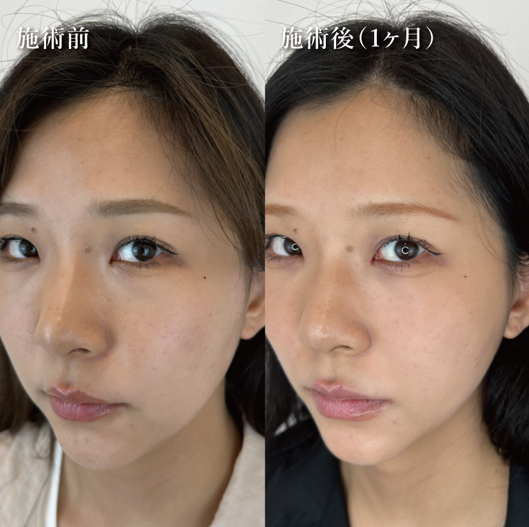 小顔美肌再生（リフトアップ）(担当医:TCB 医師)の症例写真1