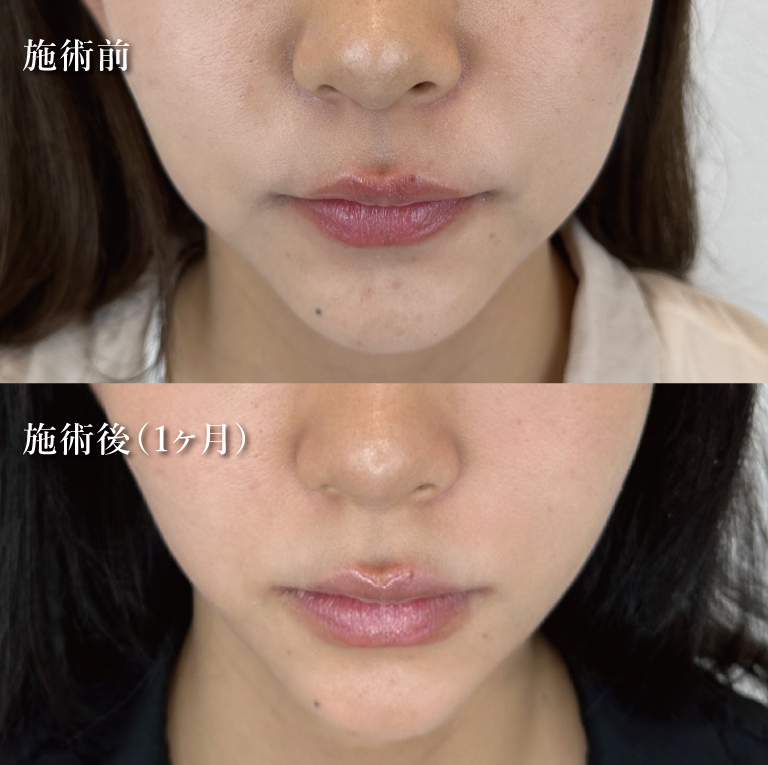 小顔美肌再生（リフトアップ）(担当医:TCB 医師)の症例写真2