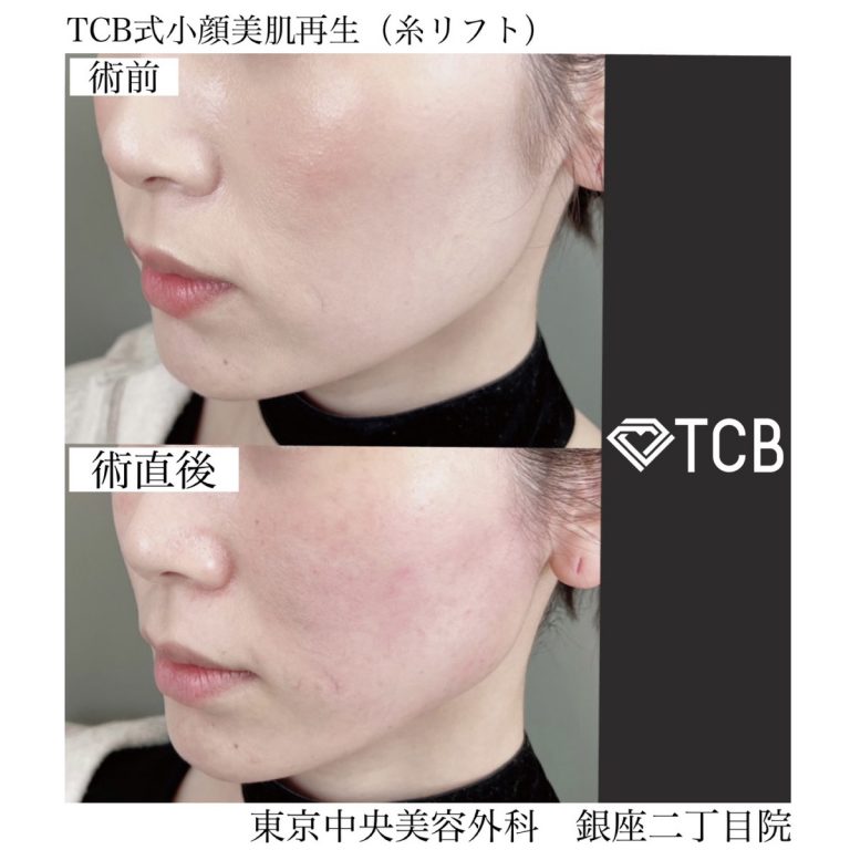 小顔美肌再生（リフトアップ）(担当医:TCB 医師)の症例写真2