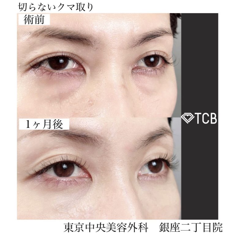 切らない目の下のクマ取り・目の下のたるみ（ふくらみ）取り(担当医:TCB 医師)の症例写真1