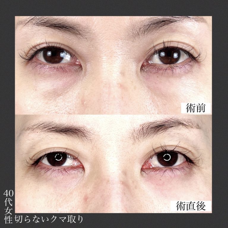 切らない目の下のクマ取り・目の下のたるみ（ふくらみ）取り(担当医:TCB 医師)の症例写真2