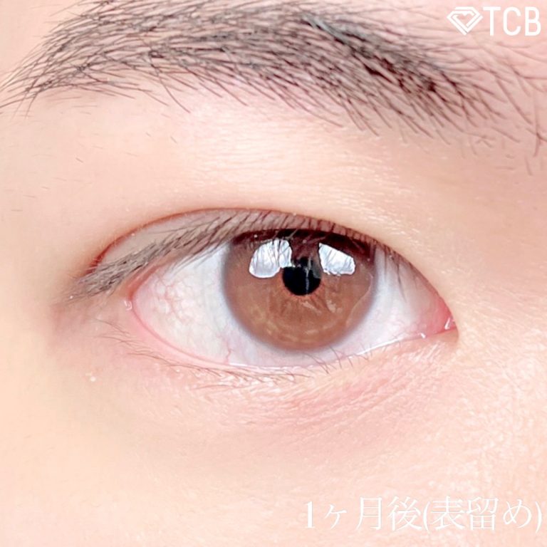 二重埋没法(担当医:TCB 医師)の症例写真2