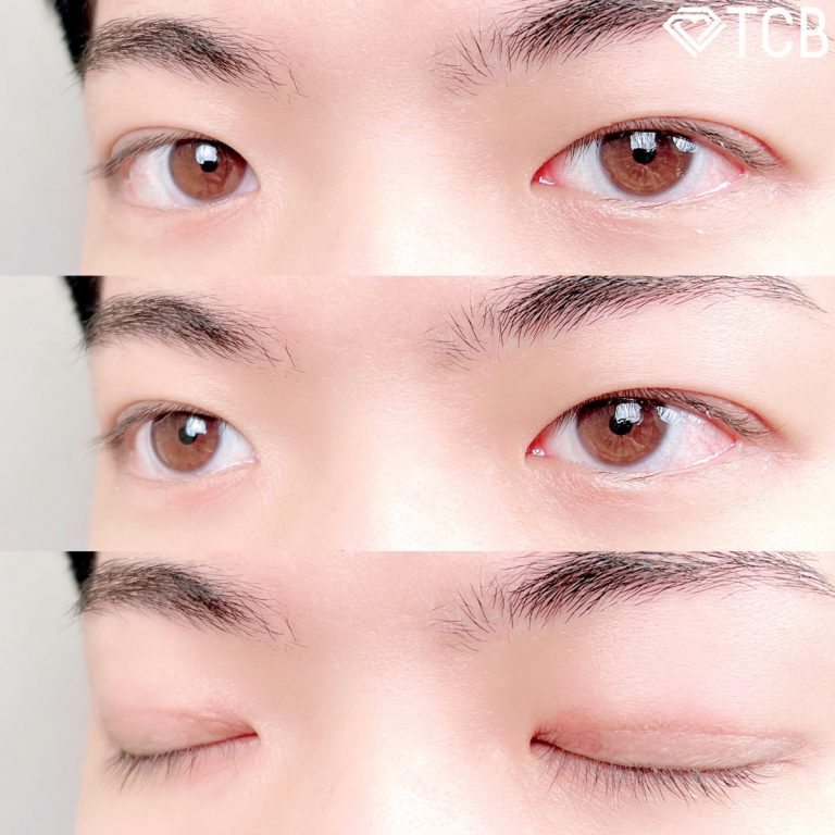 二重埋没法(担当医:TCB 医師)の症例写真3