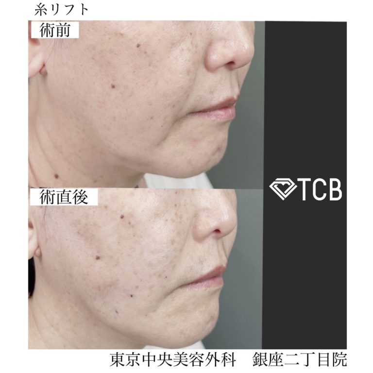 TCB式小顔美肌再生(担当医:TCB 医師)の症例写真2