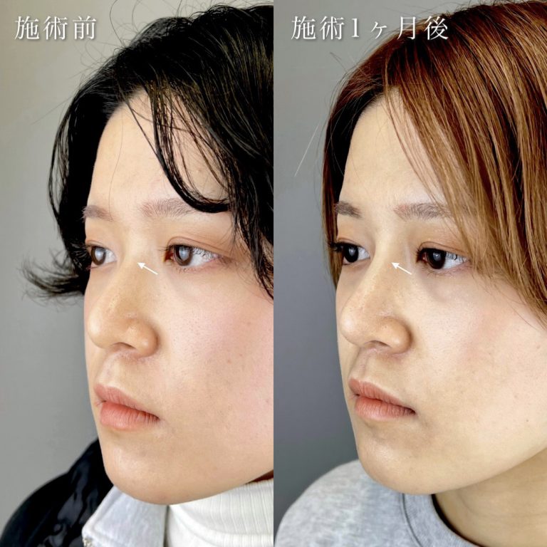 鼻プロテーゼ（隆鼻術）(担当医:河村 宜生 医師)の症例写真2