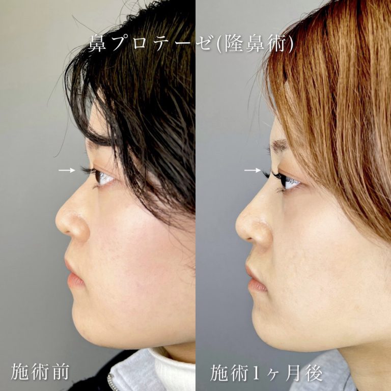 鼻プロテーゼ（隆鼻術）(担当医:河村 宜生 医師)の症例写真1