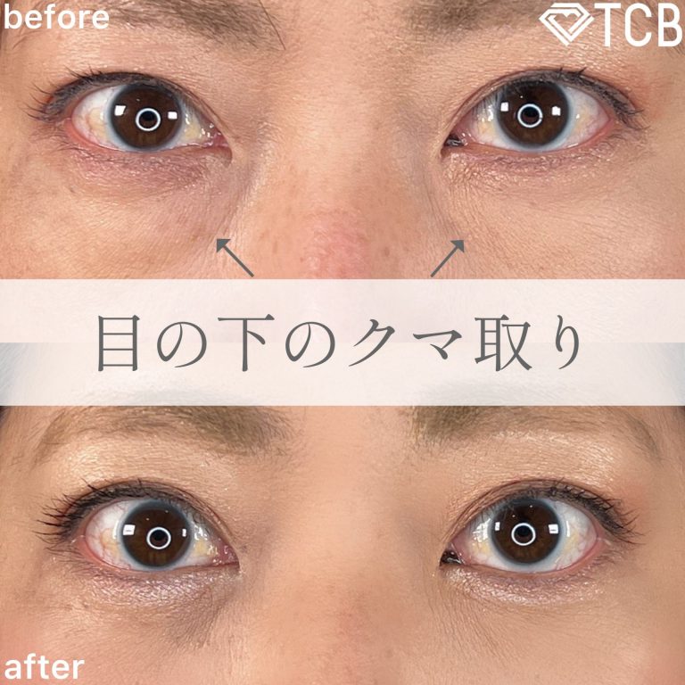 切らない目の下のクマ取り・目の下のたるみ（ふくらみ）取り(担当医:TCB 医師)の症例写真1