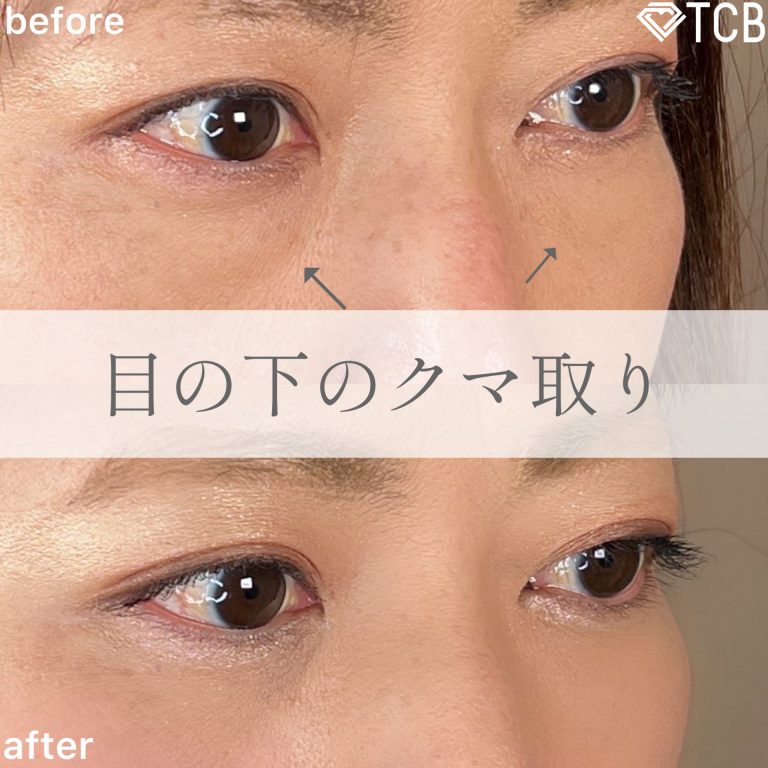 切らない目の下のクマ取り・目の下のたるみ（ふくらみ）取り(担当医:TCB 医師)の症例写真2