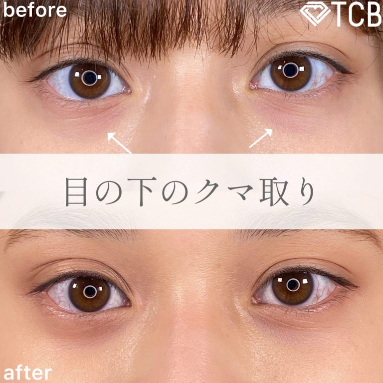 切らない目の下のクマ取り・目の下のたるみ（ふくらみ）取り(担当医:TCB 医師)の症例写真1