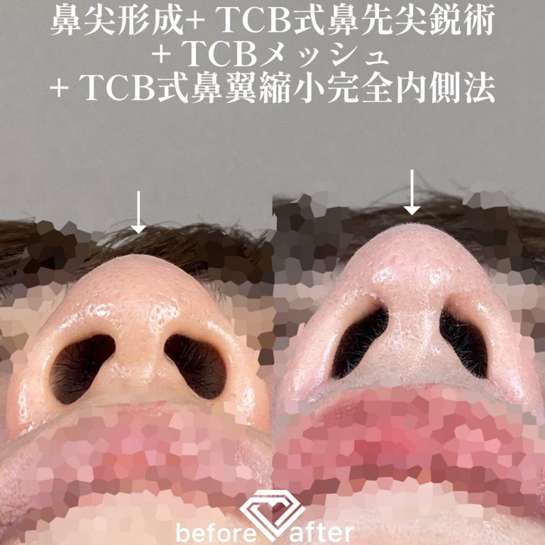 鼻尖形成(担当医:森本 理一郎 医師)の症例写真4