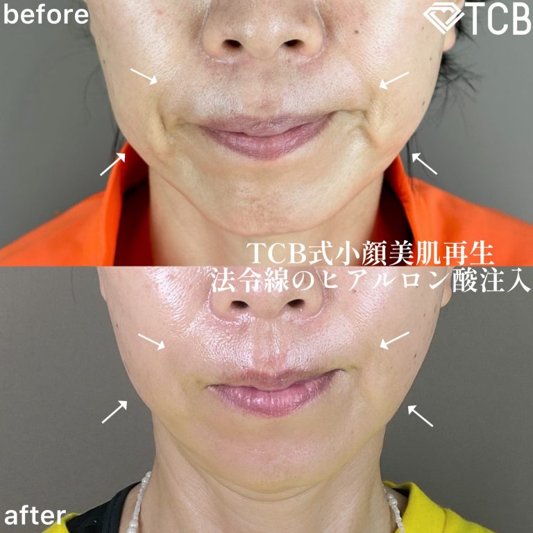 TCB式小顔美肌再生(担当医:森本 理一郎 医師)の症例写真1