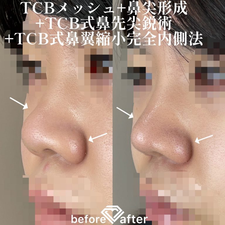 TCB式鼻先尖鋭術（だんご鼻解消）(担当医:森本 理一郎 医師)の症例写真2