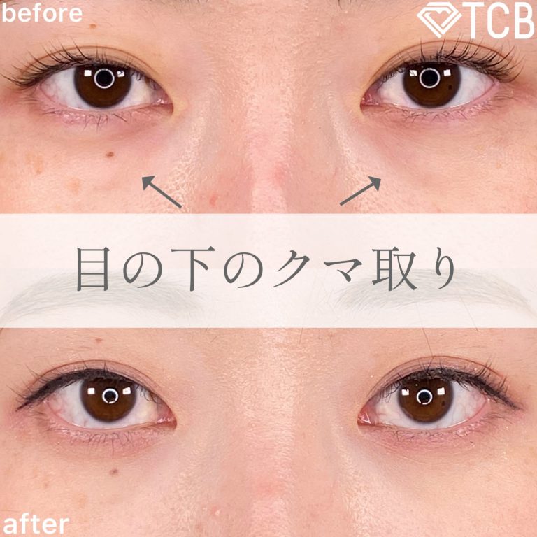 切らない目の下のクマ取り・目の下のたるみ（ふくらみ）取り(担当医:TCB 医師)の症例写真1