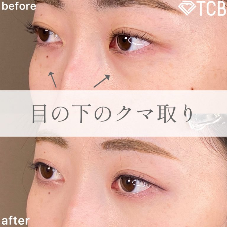 切らない目の下のクマ取り・目の下のたるみ（ふくらみ）取り(担当医:TCB 医師)の症例写真2