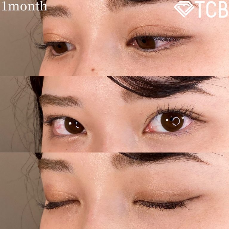 二重埋没法(担当医:TCB 医師)の症例写真2