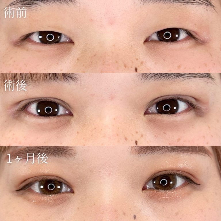 二重埋没法(担当医:TCB 医師)の症例写真1
