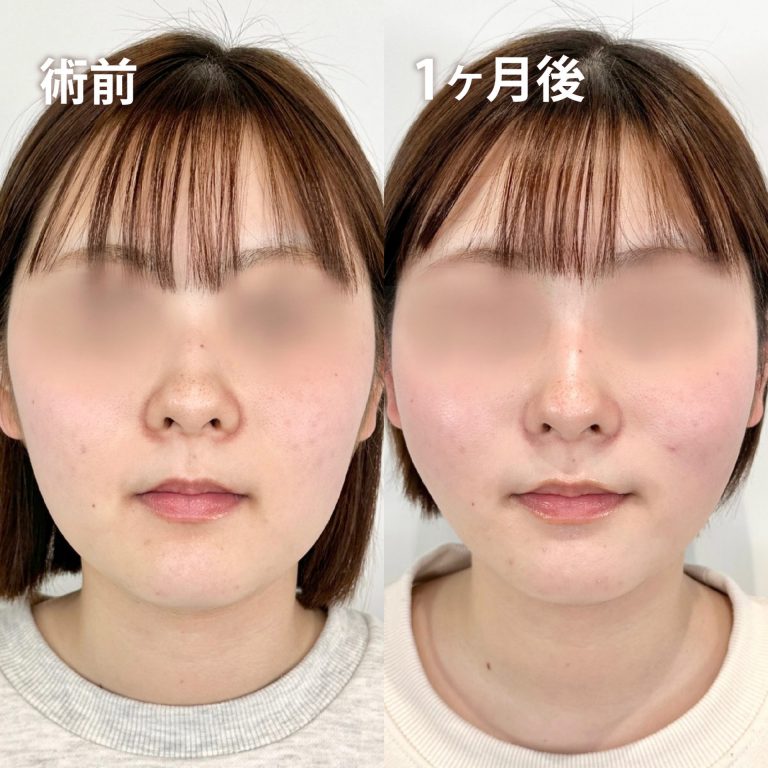 小顔美肌再生（リフトアップ）(担当医:TCB 医師)の症例写真1