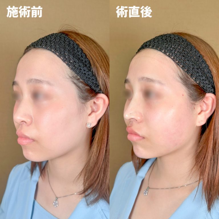 TCB式鼻先尖鋭術（だんご鼻解消）(担当医:岡本 卓也 医師)の症例写真2