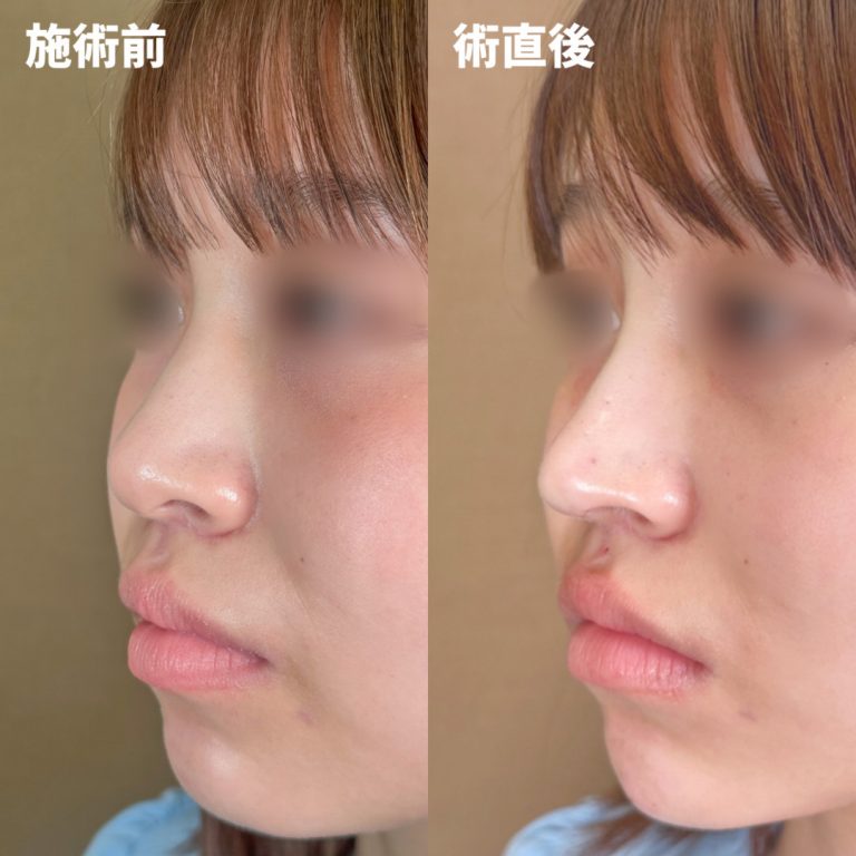 TCB式鼻先尖鋭術（だんご鼻解消）(担当医:岡本 卓也 医師)の症例写真3