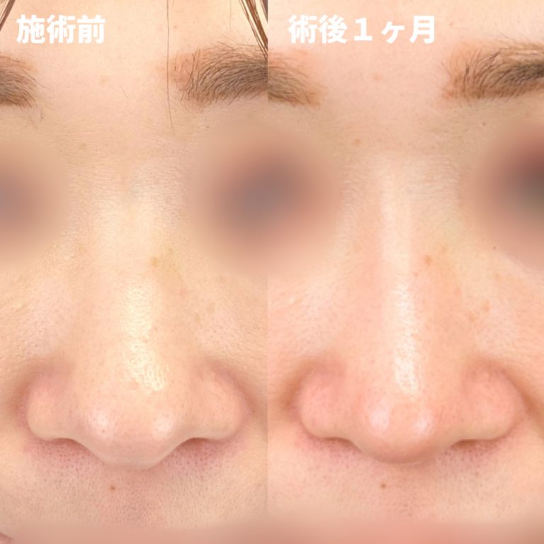 鼻尖形成(担当医:岡本 卓也 医師)の症例写真1