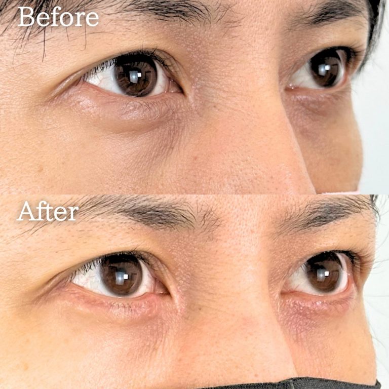 切開法による目の下のたるみ取り（下眼瞼除皺術）(担当医:TCB 医師)の症例写真1