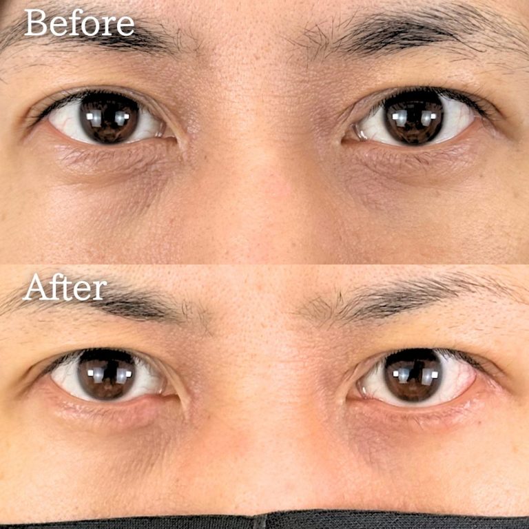 切開法による目の下のたるみ取り（下眼瞼除皺術）(担当医:TCB 医師)の症例写真2