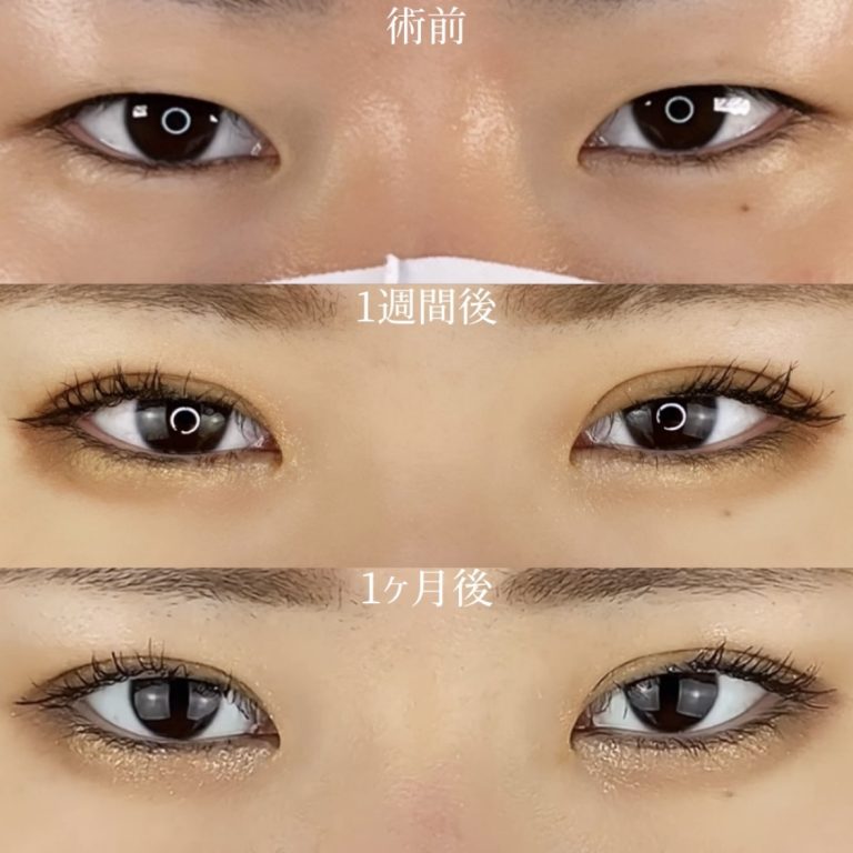二重埋没法(担当医:TCB 医師)の症例写真2