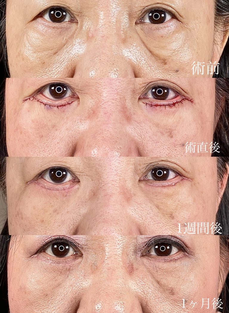 切開法による目の下のたるみ取り（下眼瞼除皺術）(担当医:森本 理一郎 医師)の症例写真2