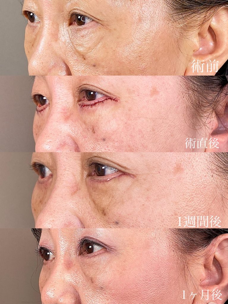 切開法による目の下のたるみ取り（下眼瞼除皺術）(担当医:森本 理一郎 医師)の症例写真3