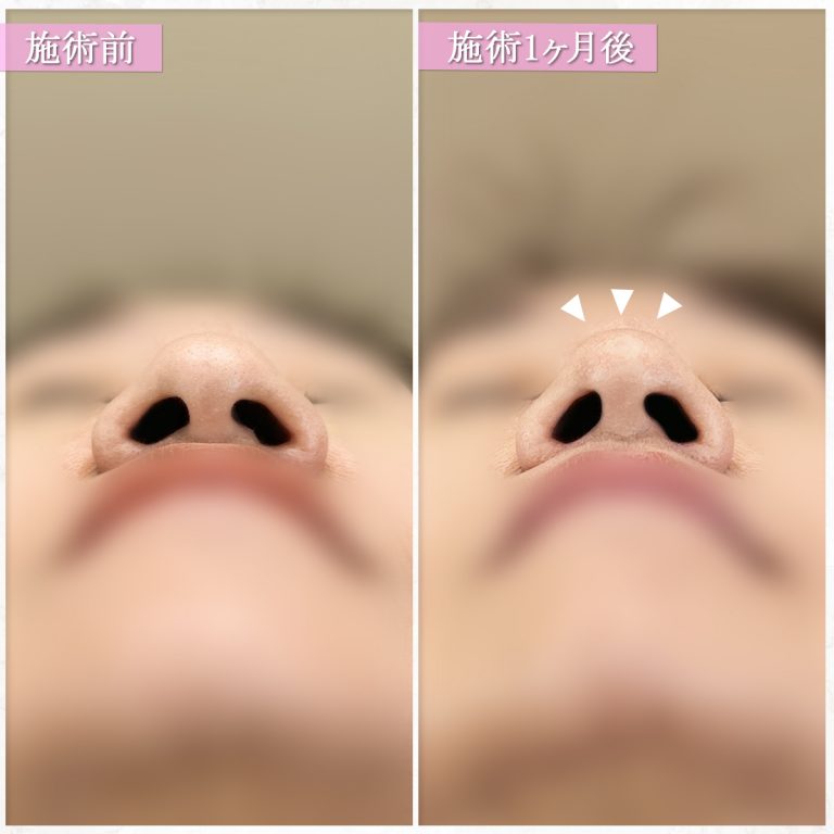 鼻尖形成(担当医:篠永 宏行 医師)の症例写真2