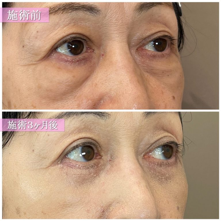 切開法による目の下のたるみ取り（下眼瞼除皺術）(担当医:篠永 宏行 医師)の症例写真2