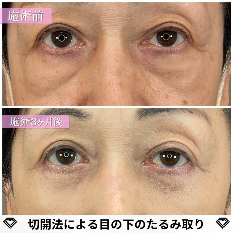切開法による目の下のたるみ取り（下眼瞼除皺術）(担当医:篠永 宏行 医師)の症例写真1