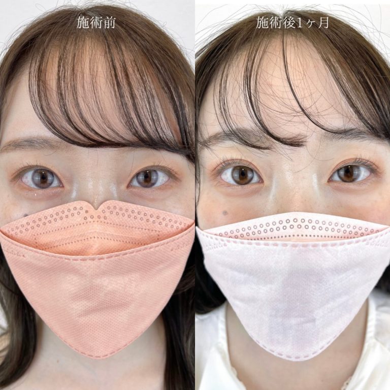 二重埋没法(担当医:TCB 医師)の症例写真1