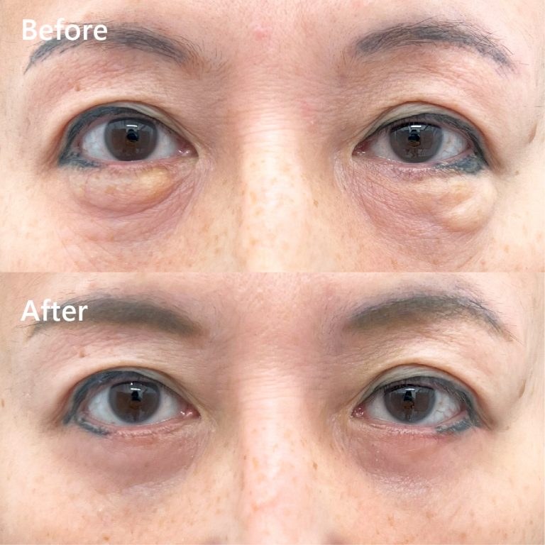 切開法による目の下のたるみ取り（下眼瞼除皺術）(担当医:坂田 将彰 医師)の症例写真1