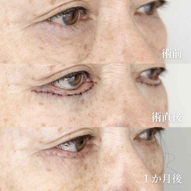 切開法による目の下のたるみ取り（下眼瞼除皺術）(担当医:垣花 瑠美子 医師)の症例写真2
