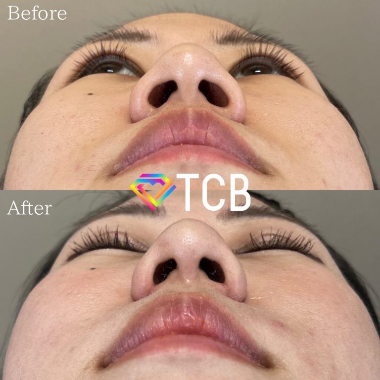 TCB式鼻翼縮小完全内側法(担当医:野田 裕太郎 医師)の症例写真1