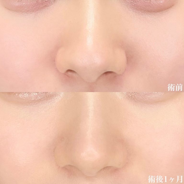 鼻尖形成(担当医:宗 茉裕子 医師)の症例写真1