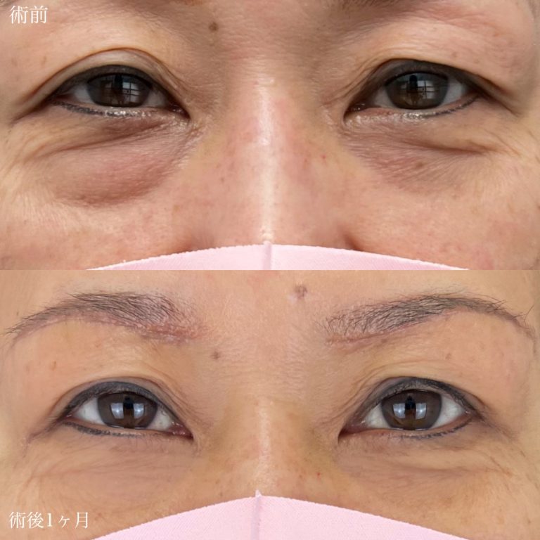 切らない目の下のクマ取り・目の下のたるみ（ふくらみ）取り(担当医:宗 茉裕子 医師)の症例写真1