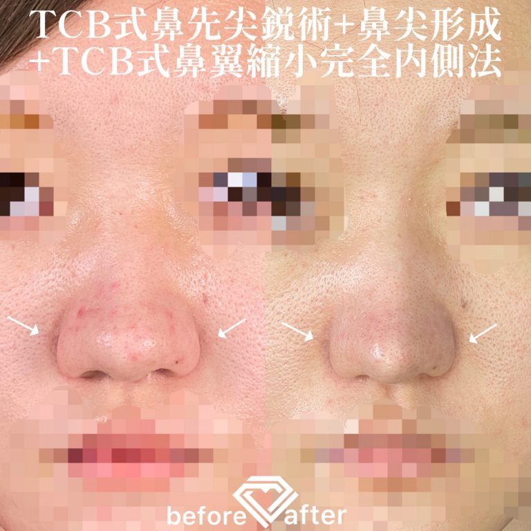 TCB式鼻先尖鋭術（だんご鼻解消）(担当医:TCB 医師)の症例写真1