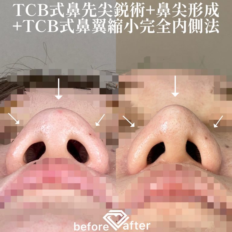 TCB式鼻先尖鋭術（だんご鼻解消）(担当医:TCB 医師)の症例写真4