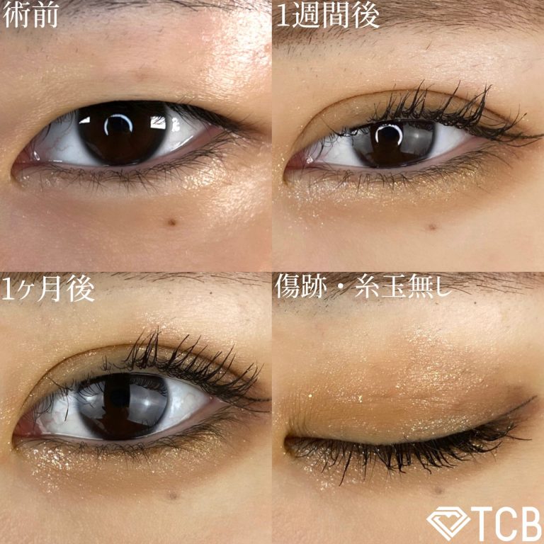 二重埋没法(担当医:TCB 医師)の症例写真1