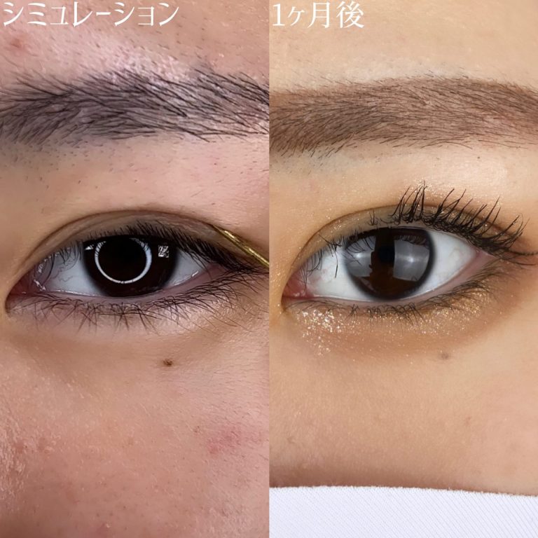 二重埋没法(担当医:TCB 医師)の症例写真3