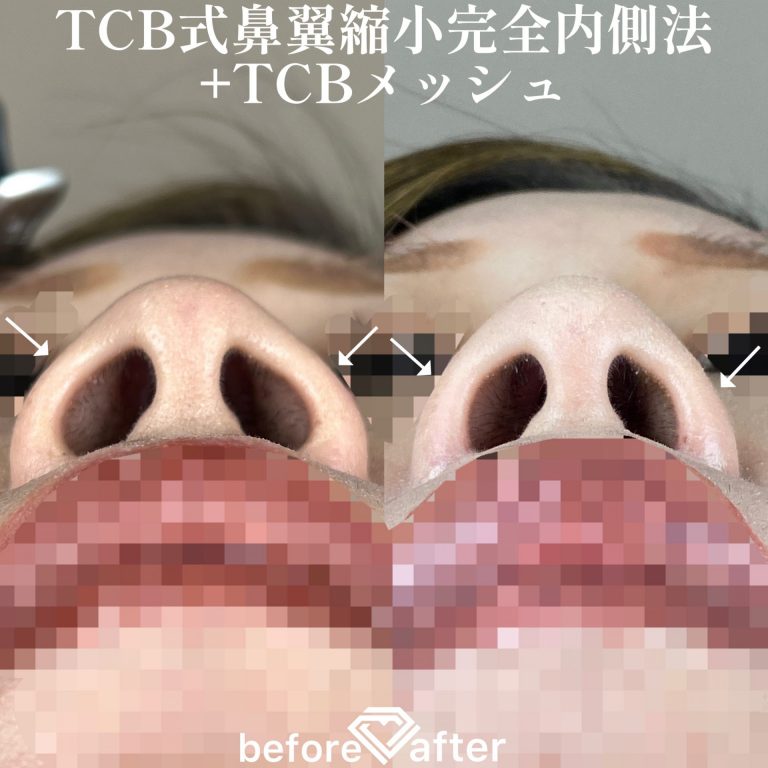 TCBメッシュ(担当医:森本 理一郎 医師)の症例写真3