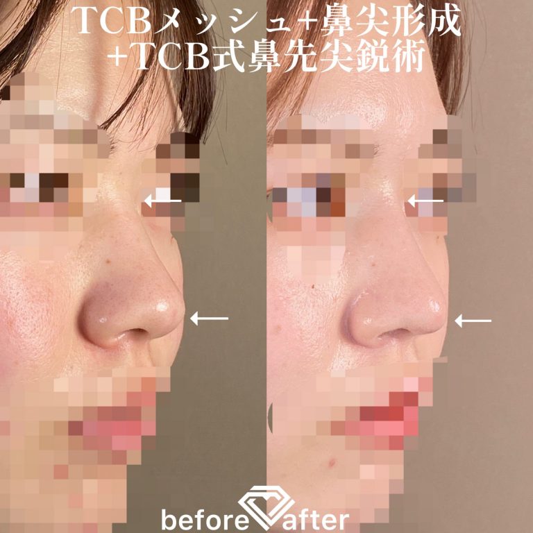 TCB式鼻先尖鋭術（だんご鼻解消）(担当医:TCB 医師)の症例写真2