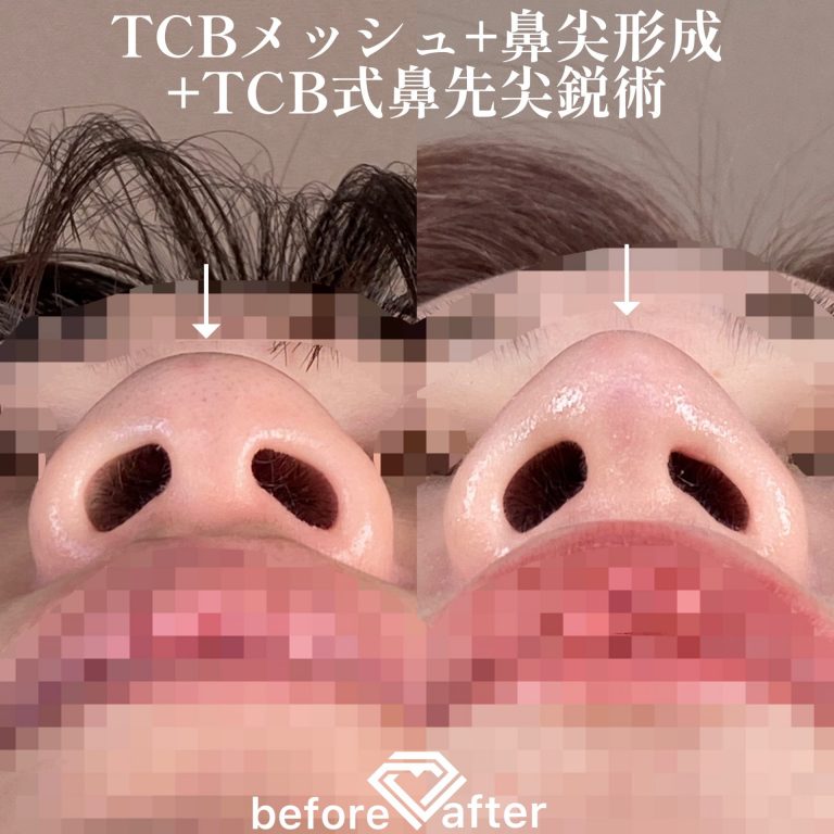 TCB式鼻先尖鋭術（だんご鼻解消）(担当医:森本 理一郎 医師)の症例写真4