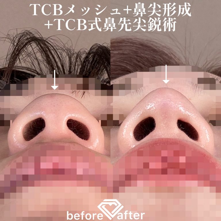 TCB式鼻先尖鋭術（だんご鼻解消）(担当医:TCB 医師)の症例写真4