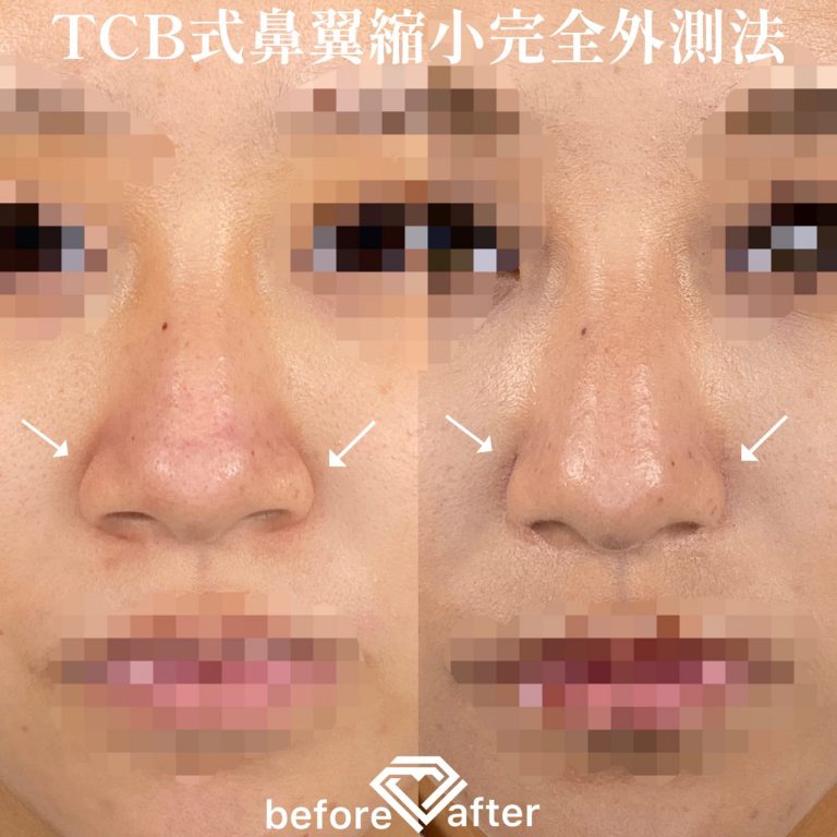 TCB式鼻翼縮小完全内側法・外側法(担当医:TCB 医師)の症例写真1