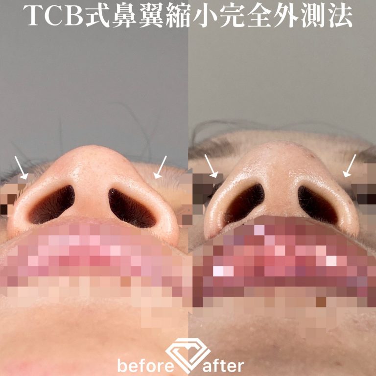 TCB式鼻翼縮小完全内側法・外側法(担当医:TCB 医師)の症例写真3